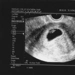 Замершая беременность: признаки, симптомы, методы профилактики Подозрение на замершую беременность на 5 неделе