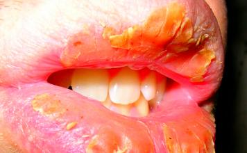Zdravljenje soorja v ustih pri otrocih: simptomi in zdravila za novorojenčka in starejšega otroka Soor na jeziku dojenčka zdravljenje